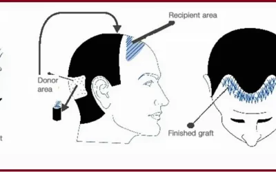 Why should you go for direct, FUE hair Transplant